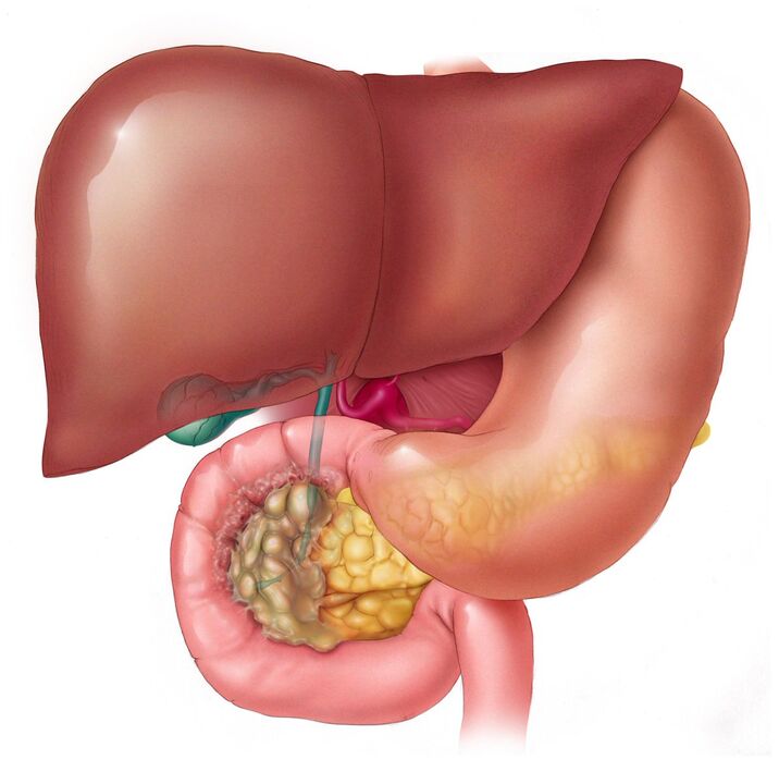 Jak usunąć pasożyty z wątroby