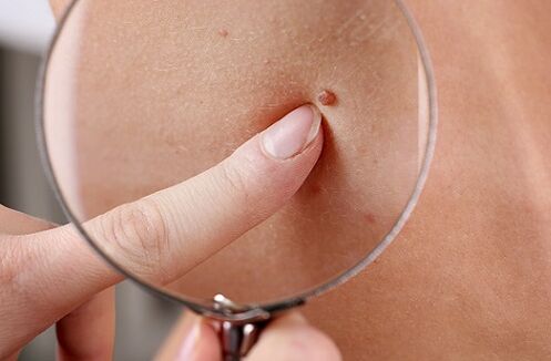 brodawczak jako objaw pasożytów