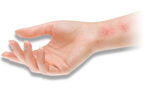 reakcja alergiczna na pasożyty