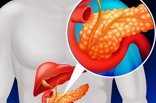 żółciowe zapalenie trzustki z pasożytami