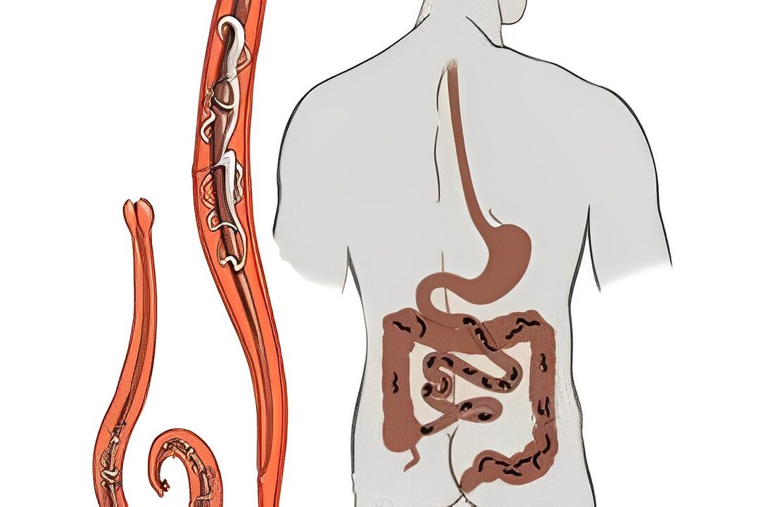 oznaki infekcji robakami